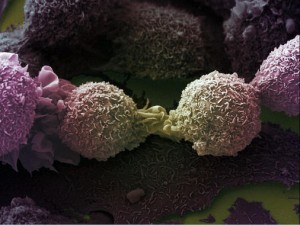 B0007213 Lung cancer cells