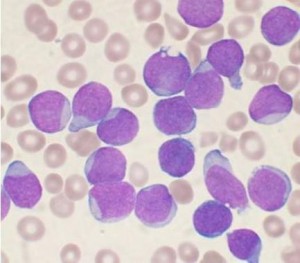 células de leucemia linfoblástica aguda. / Wikipedia